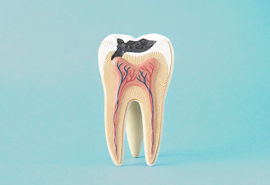 Root canal treatment