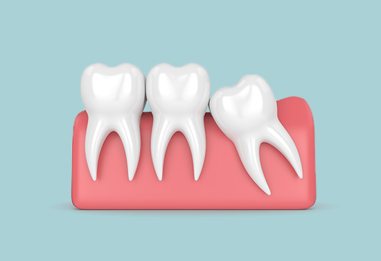 Wisdom tooth extraction